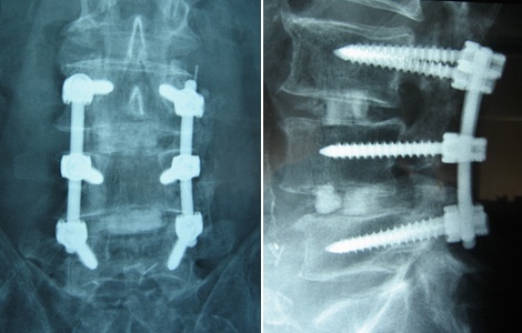 Chiropractic Reduces Likelihood of Surgery